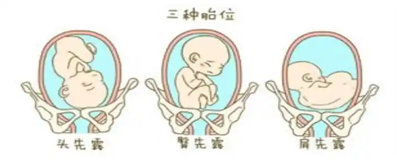 臀位如何纠正胎位