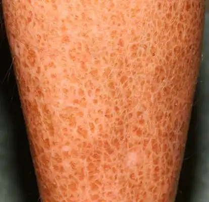 鱼鳞病初期图片 (68)