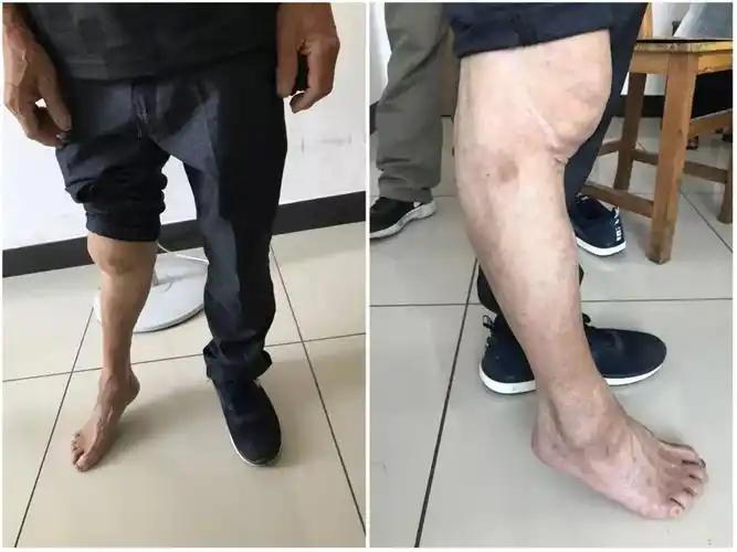 胫骨平台过伸内翻型骨折怎么诊断和治疗?