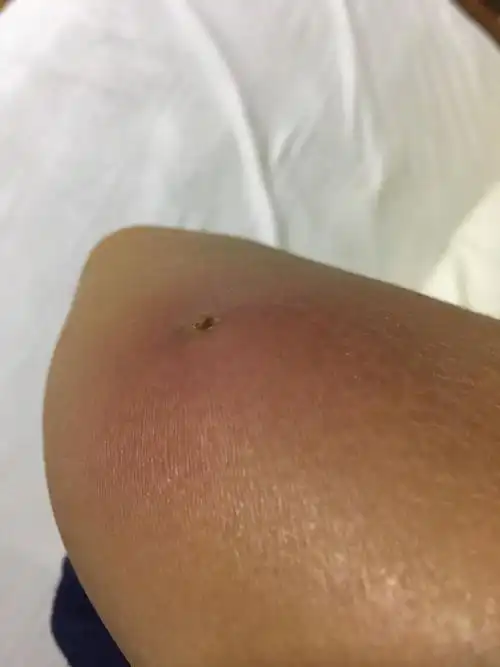 胳膊上起了一个大包,有点肿,特别疼,里面是像浓一