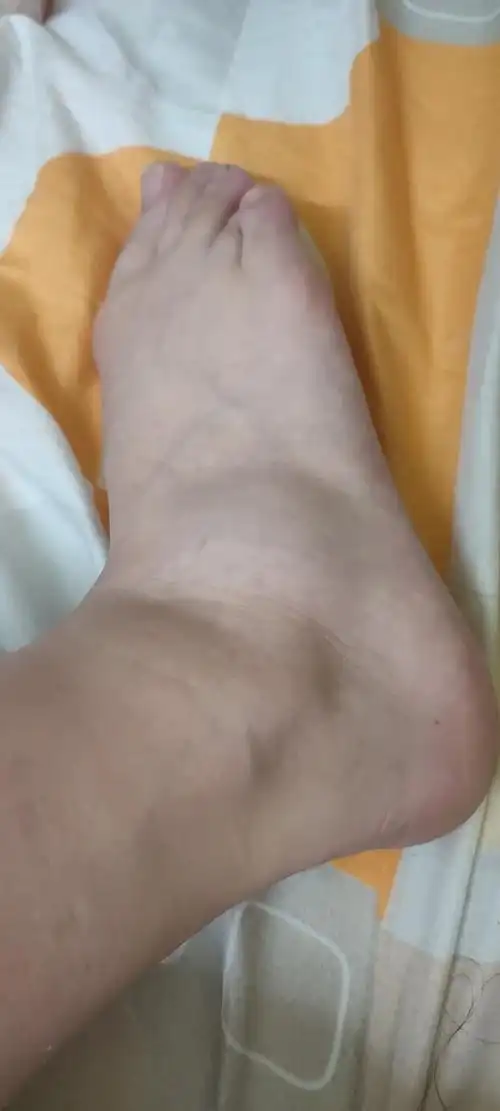 崴了脚起了个大包走不了路偏偏来姨妈还是蹲厕