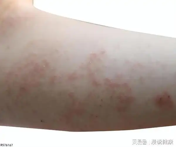 2种症状,每一个都不太好受|疥疮|疥虫|瘙痒|寄生虫|疥螨目_网易订阅