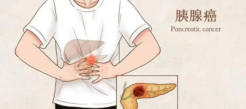 局部晚期胰腺癌50治愈率这家美国哈佛医院是怎么做到的