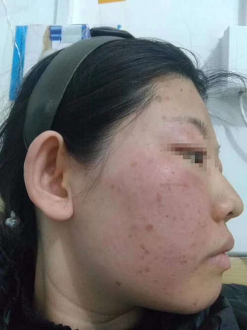 hpv跟我们之间的距离并不仅仅是癌症和性病,还有小小的扁平疣_扁平疣