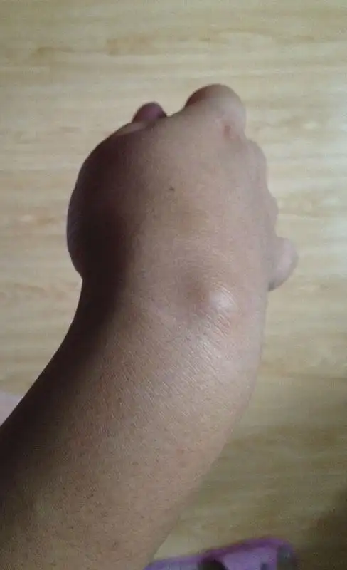 手腕上长了个包,网上搜了一下,好像是腱鞘炎,目前不痛不痒,需不需要去