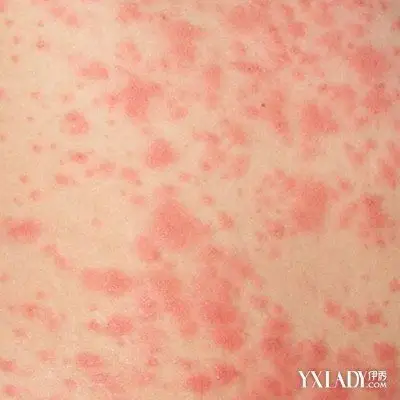 【图】身上过敏起疙瘩很痒怎么办 了解5大原则减少过敏复发