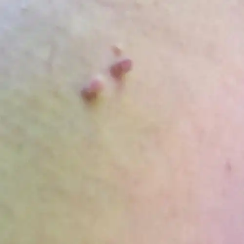 在腋窝下边长了两个小肉揪是什么