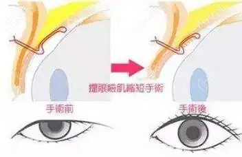 中度上睑下垂的人做额肌瓣悬吊好还是提肌手术好