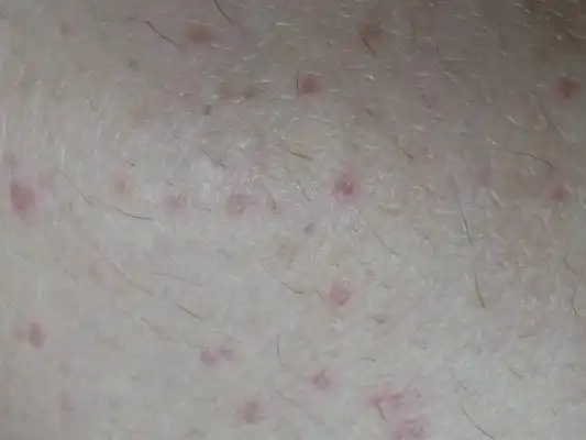 艾滋病大腿上红点图片 (6)