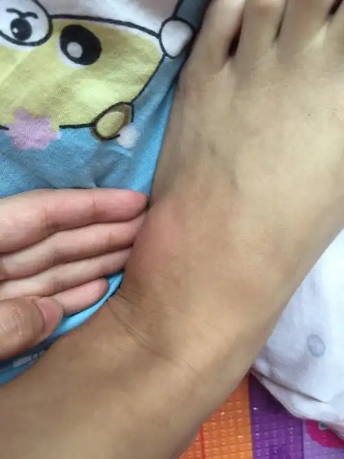 脚上无缘长了个大包,之前有点痒,现在不痒按下去有点痛,平时自己也很