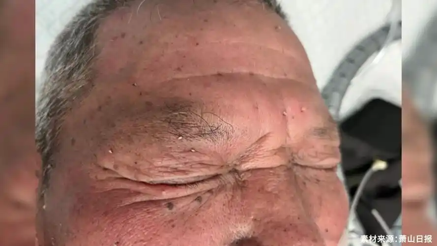 吓人老伯欲带蜂窝回家养被蛰致休克医生10多分钟拔出50多根蜂针