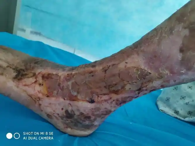 从手术到植皮皮肤完全恢复,紧用半个月的时间.