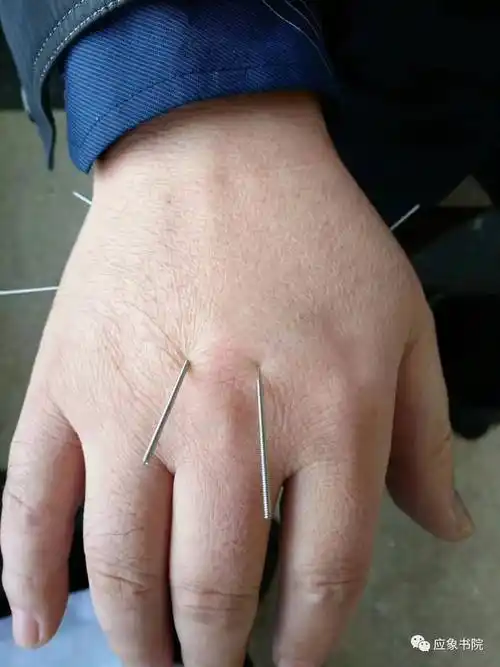 全息易象针灸|临床实操——肩胛骨痛