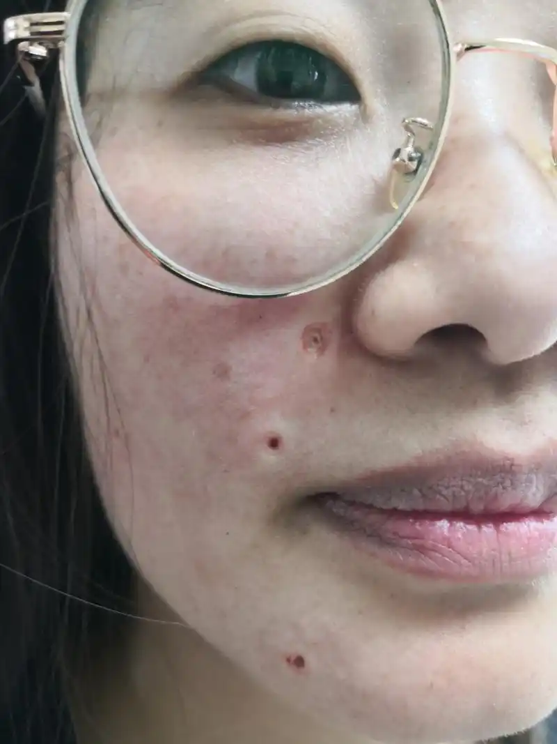 面部色素痣激光治疗去除后即刻图片.