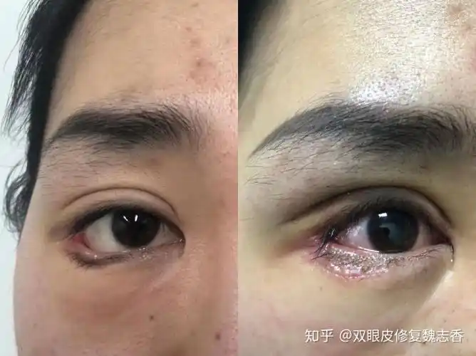 下睑下至案例解析修复方案