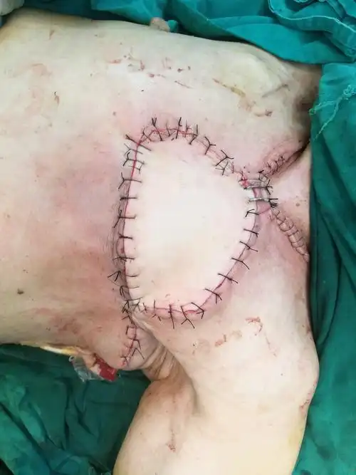 局部晚期乳腺癌创面修复 - 好大夫在线