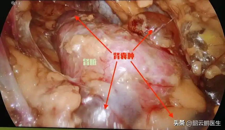 肾囊肿的治疗如何选择?