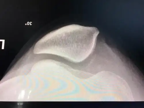 关节镜下微创治疗髌骨脱位