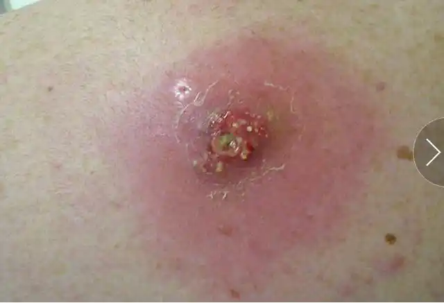 鉴别细菌性皮肤病 挑战你的诊断力