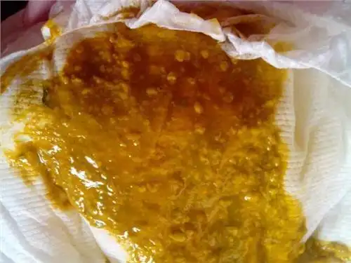 婴幼儿拉稀屎是酸臭的是怎么回事