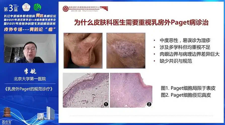 首先由皮肤外科泰斗级人物——北京大学第一医院李航教授带来《乳房外