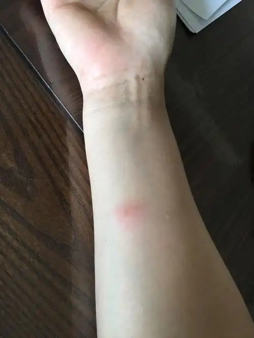 我做完ppd后胳膊有红晕还有点硬 是阳性的吗