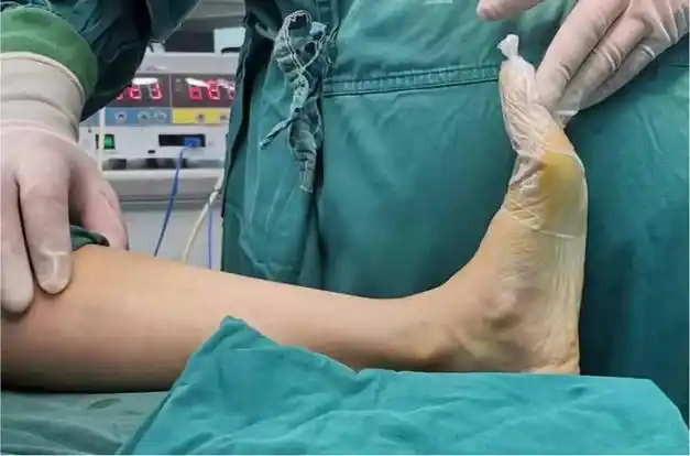 寿光综合医院首例平足症矫形手术成功完成