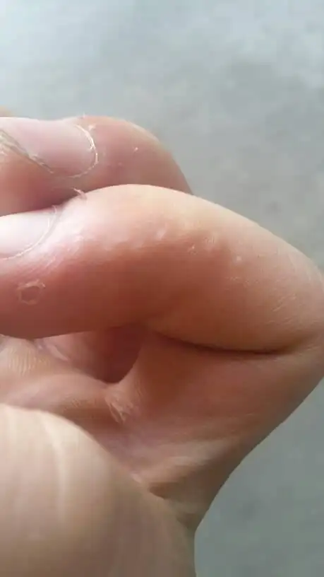 手上这些小疙瘩是怎么回事每个手指都有有多有少