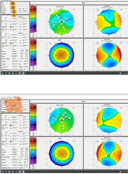 全飞秒术后一个月用药和复查的角膜地形图