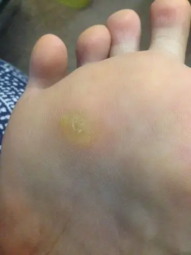 我脚底三四趾下方几个月前因为长时间走路长了个黄色小包,开始以为是