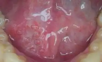 男性尖锐湿疣早期表现症状广告[在线问诊]生殖疱疹图片 真实图文对比