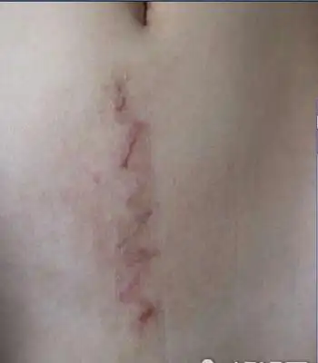 子宫,这时是和死神争分夺秒,母子性命最重要,也就顾不得疤痕的好看