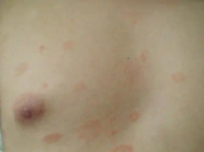 楼主clould022007-10-13 10:17:34:( :( :( 1个月前出现斑片状与