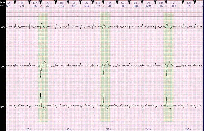 心电图病例分析:左前分支型室性早搏