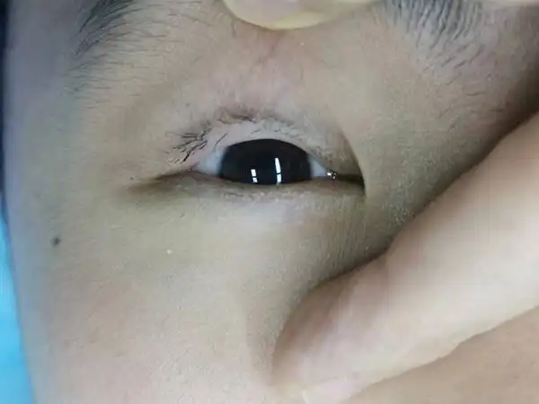 男孩剪掉倒睫毛以方便医生做手术,岂料好心办坏事