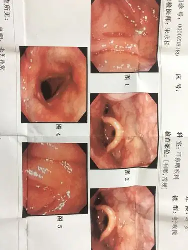 这是我的电子喉镜,最近感觉鼻子不舒服,看了一下鼻子内壁很红,像充血