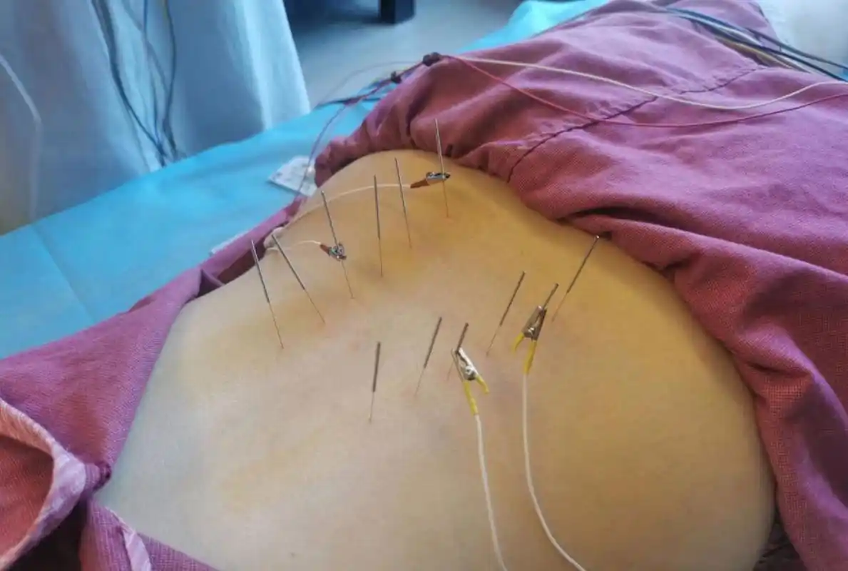 针灸真的好神奇 前段时间咳嗽,咳的整个后背右边的膀胱经都是 疼的