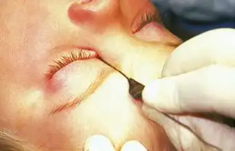 鼻泪管阻塞怎么办?