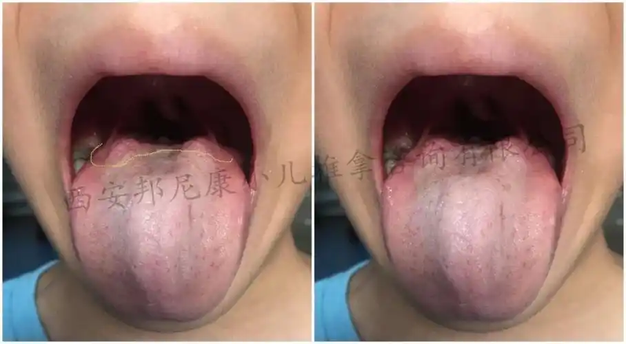 小儿舌诊临床案例—鼻甲肥大,腺样体肥大,上颌窦炎全都有