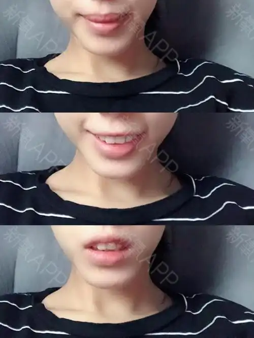 我的皮肤比较薄,图二那个是我的青筋,不是淤青哦!