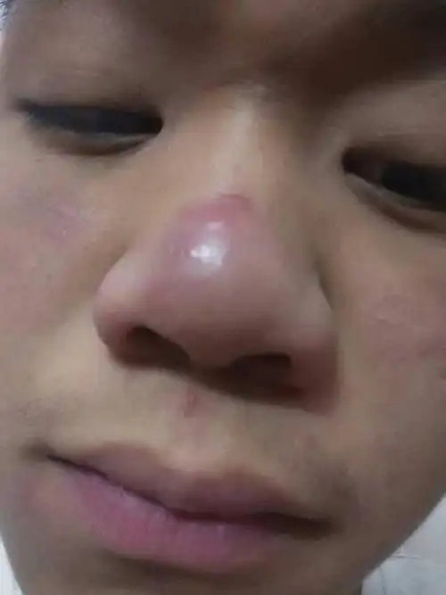 我的鼻子怎么会皮肤红的