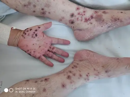 变应性血管炎治疗前后比较 - 好大夫在线