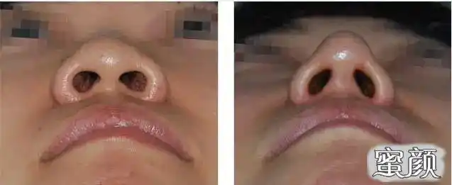 通过整形手术,可以调整鼻软骨,延长鼻小柱,根据情况,可以移植一块软骨