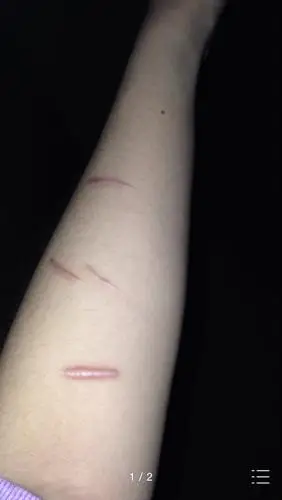 手上的刀疤半年了,突起,有时候偶尔会痒,有点硬,请问这是增生性疤痕吗