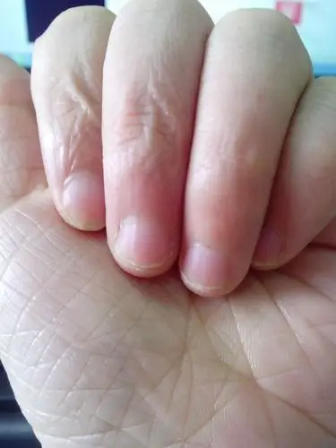 这指甲正常么