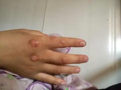 指关节变黑变硬,像茧一样,剪掉之后慢慢的又变厚变硬,有时候有点痒