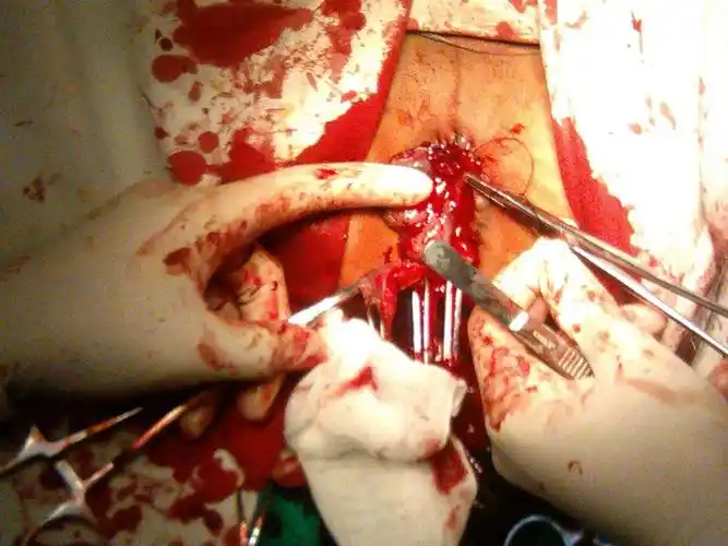 痔疮外痔肉球图片