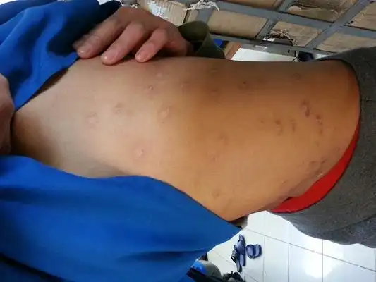 男性疥疮图片51