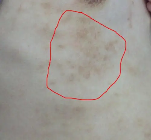 胸口下长的黑色斑点,不知道是什么?请懂皮肤的专家帮我看下!