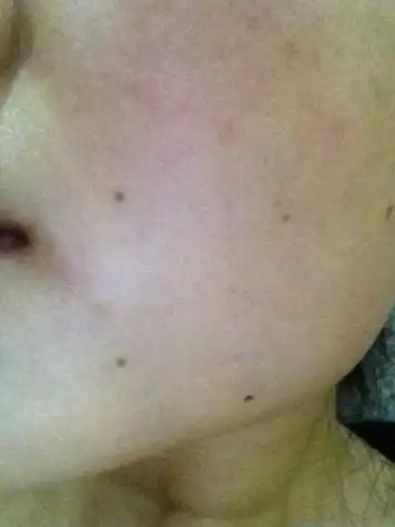 最近一段时间脸上忽然冒出很多这种黑点,是黑痣嘛?